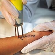 tattoo removal pinellas